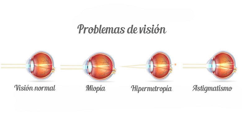 Qué es el astigmatismo, la miopía, la hipermetropía y la presbicia